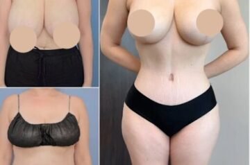 How to Find the Best Tummy Tuck Surgeon in Dubai for Your Body Goals